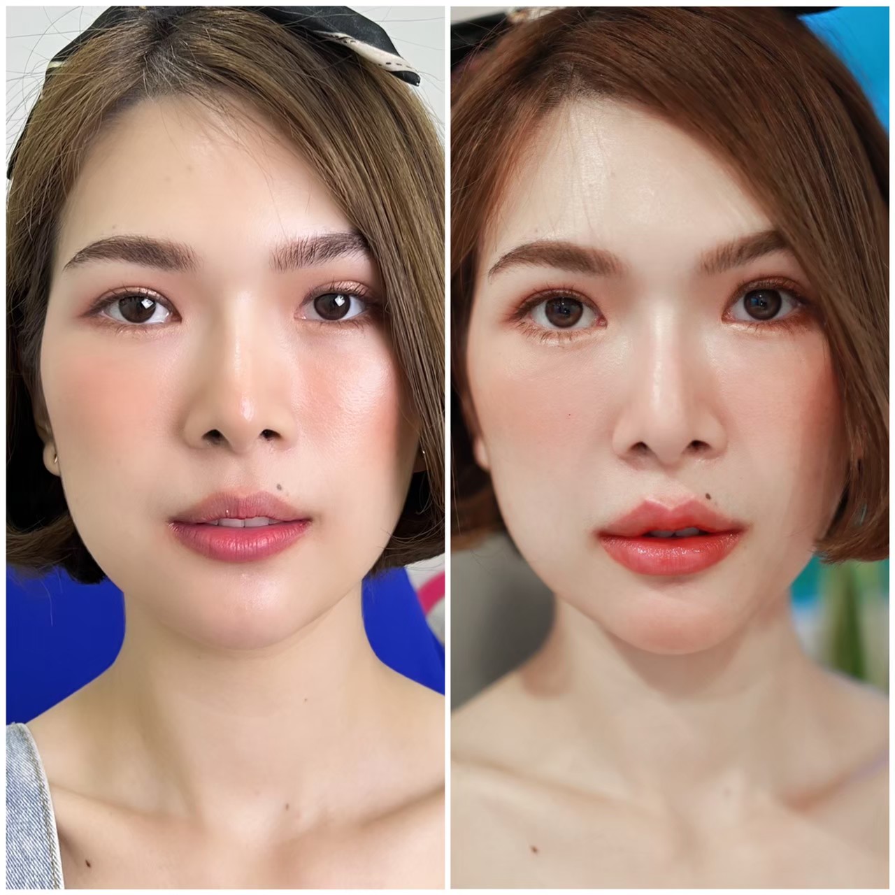 Before and after lip filler results at Charmer Clinic Bangkok